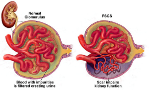 fsgs