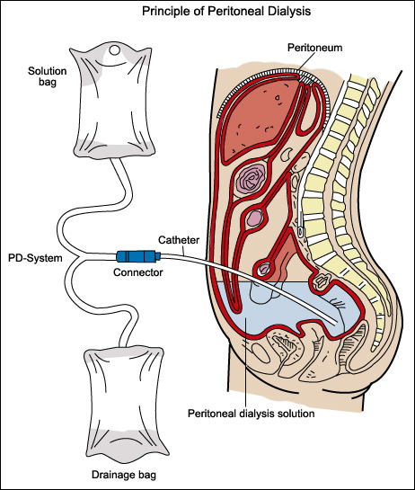 peritoneal dialysis diagram