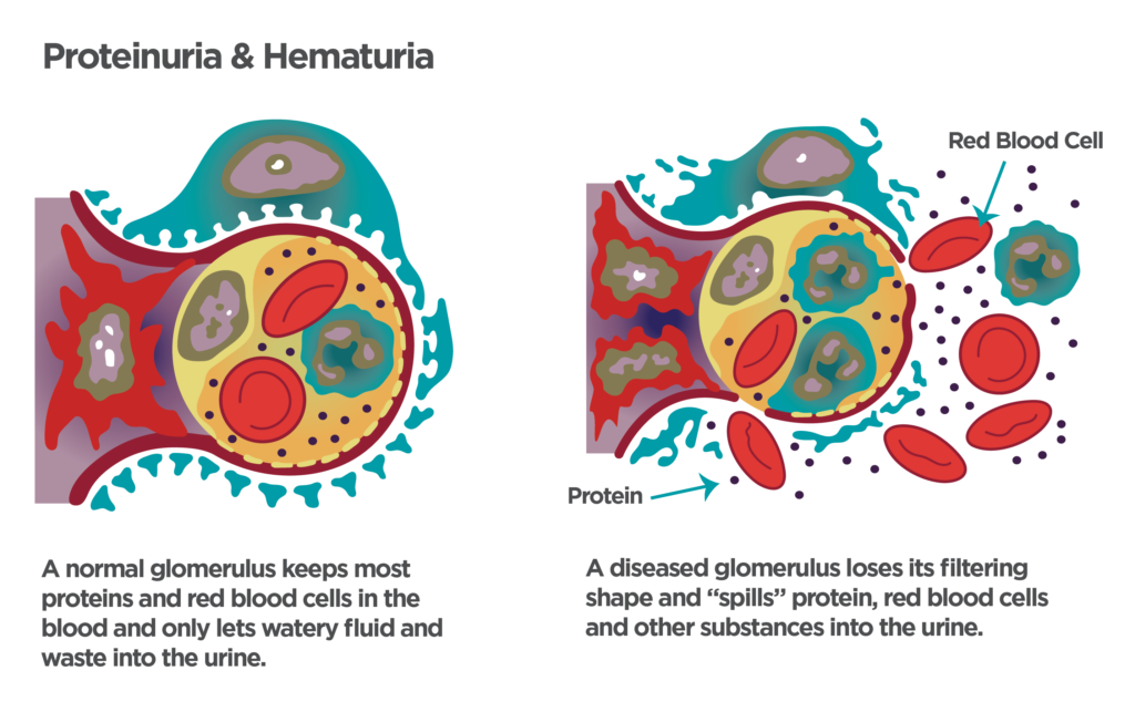 Normal and diseased kidney glomerulus