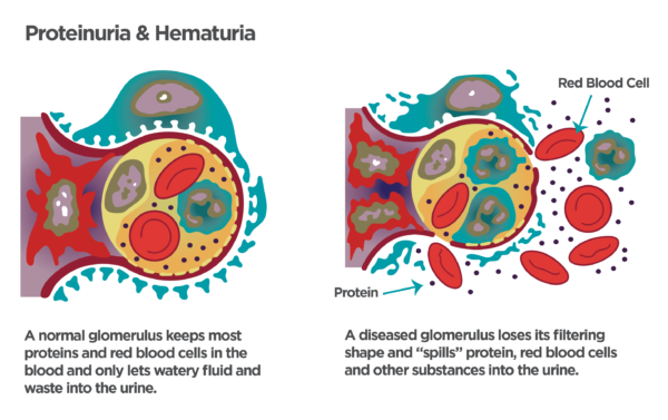 Newly Diagnosed Learn About Nephrotic Syndrome In Adults Nephcure 8752